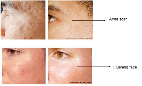 Micro-needle RF Acne Scar Removal Machine