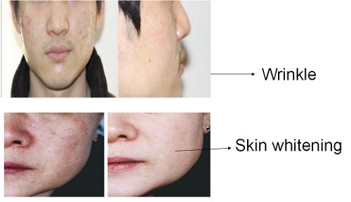 Micro-needle RF Acne Scar Removal Machine