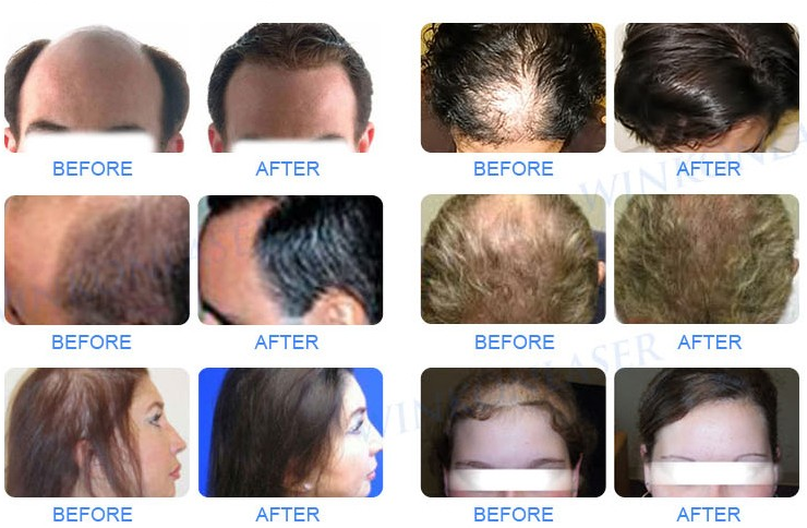 Laser Hair Loss Hair Regrowth MachineLaser Hair Loss Hair Regrowth Machine