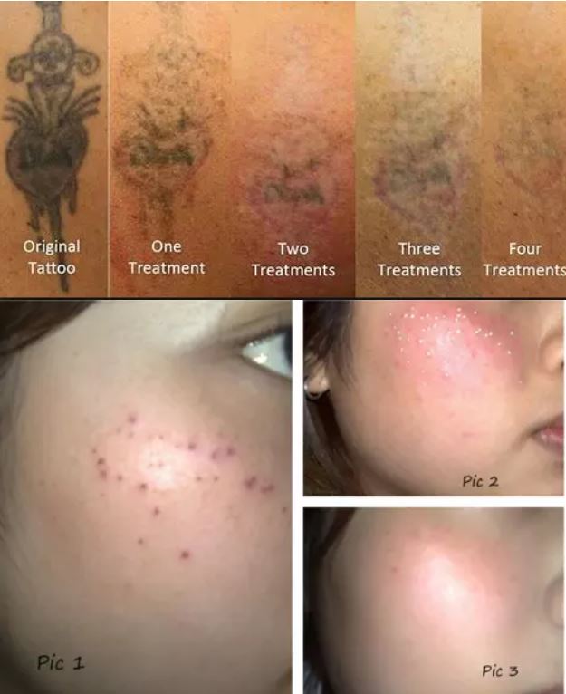 Q Switch Powerful ! Nd Yag Laser /Pico Second Q Switched Nd Yag Laser Picosure