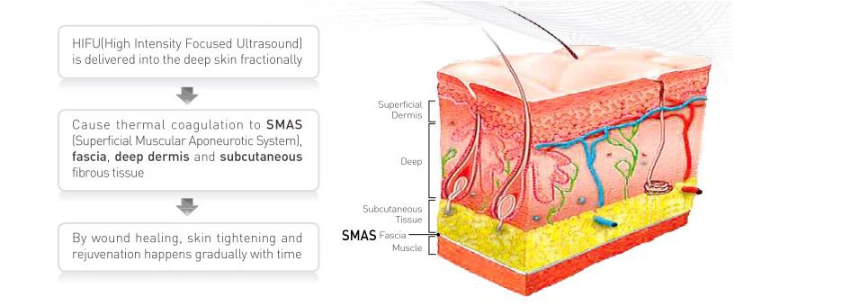Best Sales Hifu For Face Lifting And Slimming Machine