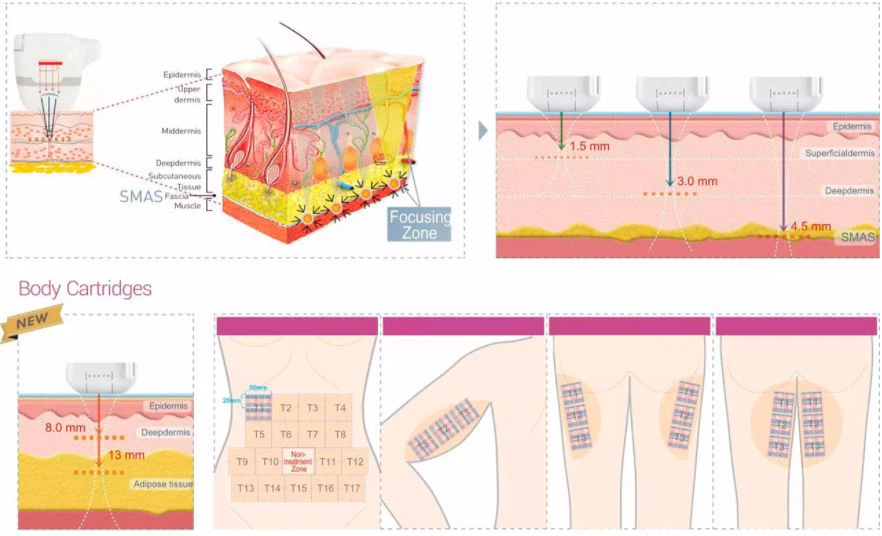 Best Sales Hifu For Face Lifting And Slimming Machine